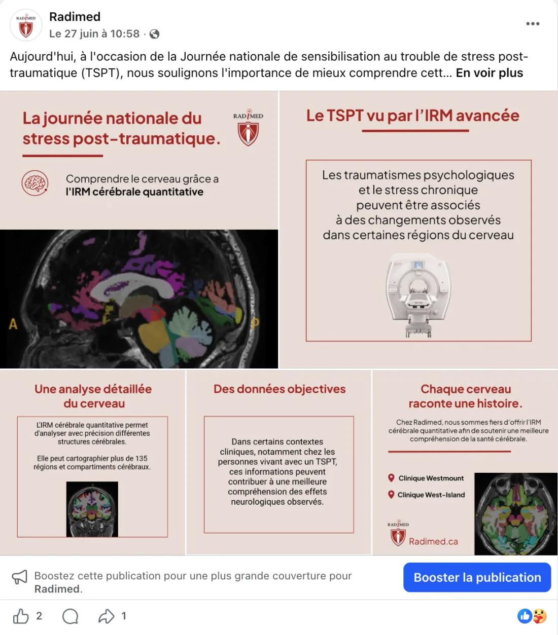 Radimed Facebook carousel for PTSD awareness day: quantitative brain MRI explained across five panels